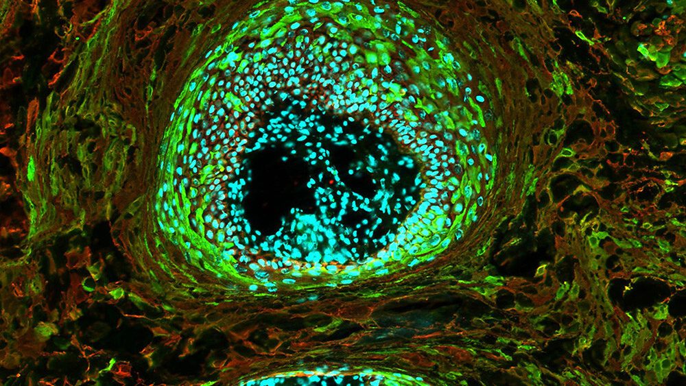 Cancer les nouvelles découvertes